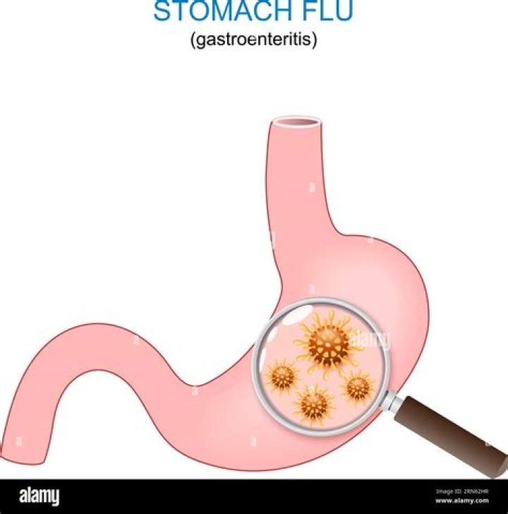What is a stomach flu virus?