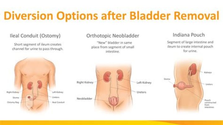 What is an Indiana pouch bladder?