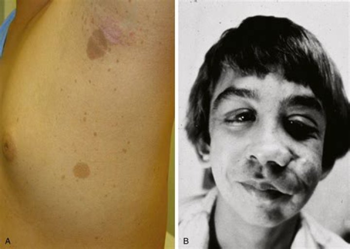 What is axillary freckling?