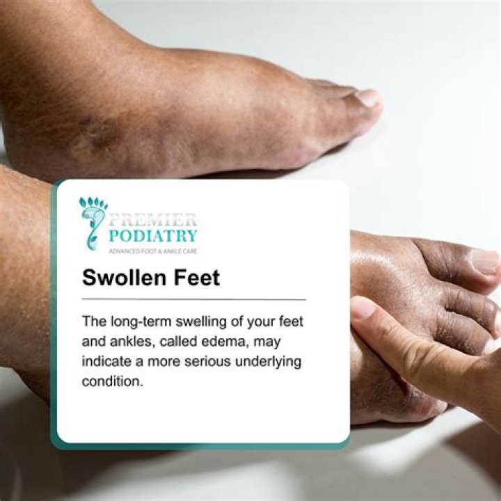 What is good to drink for swollen feet?