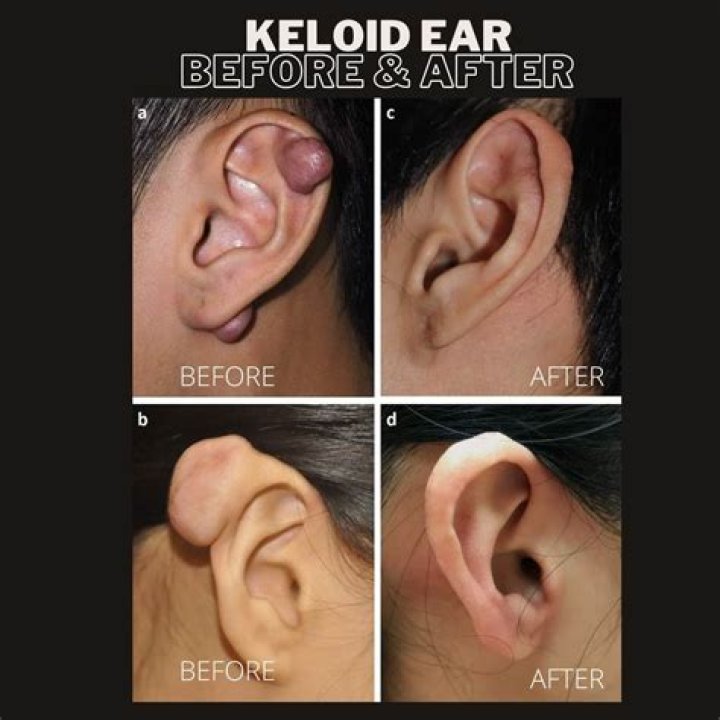What is inside a keloid?