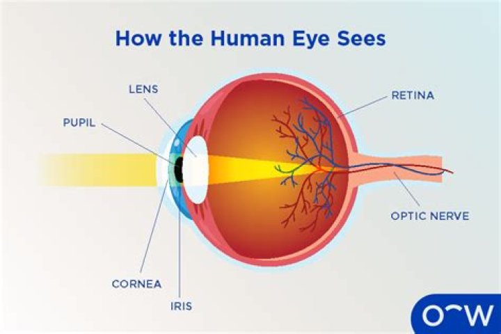 What is iris hamartoma?