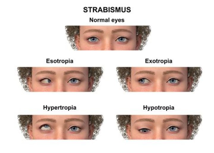 What is it like to have strabismus?