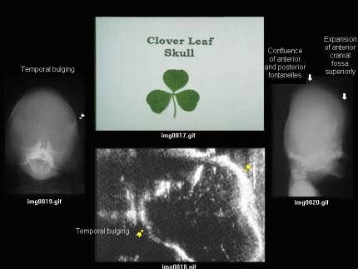 What is Kleeblattschadel?