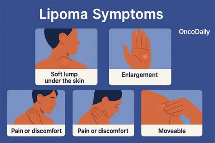 What is lipoma in mouth?