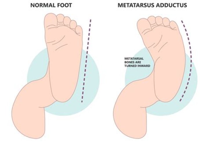 What is pigeon toed?