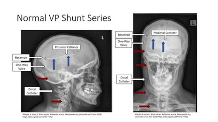 What is series and shunt fault?