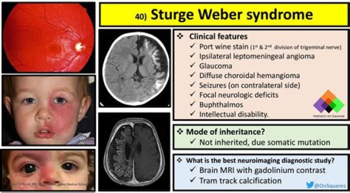 What is Sturge-Weber syndrome?