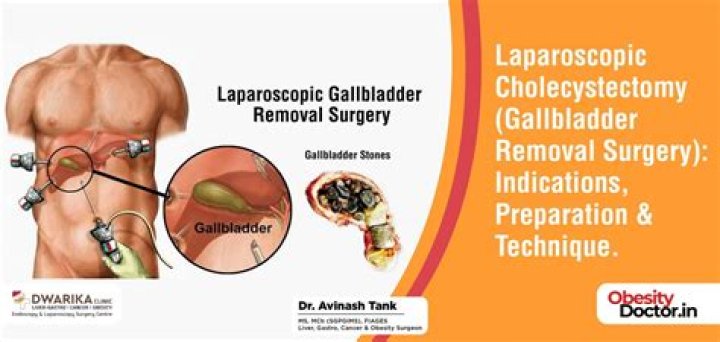 What is the criteria for gallbladder surgery?