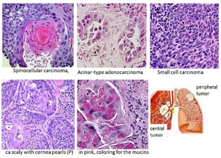 What is the difference between adenocarcinoma and carcinoma?