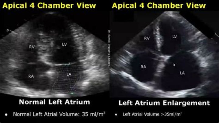 What is the difference between an ultrasound of the heart and an echocardiogram?