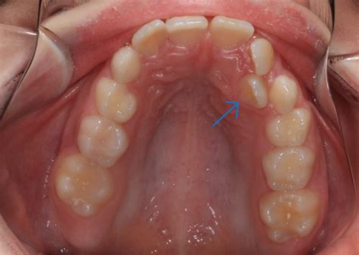 What is the extra tooth called?