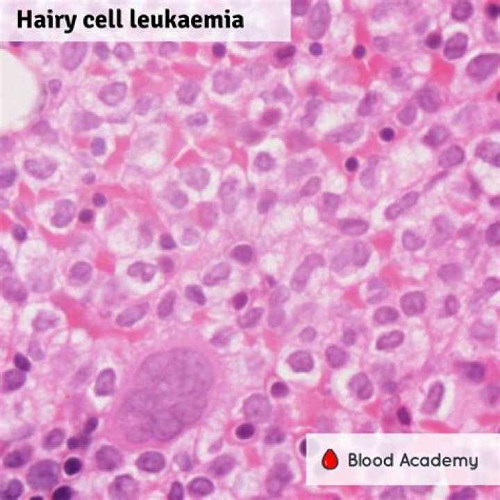 What is the life expectancy of someone with hairy cell leukemia?
