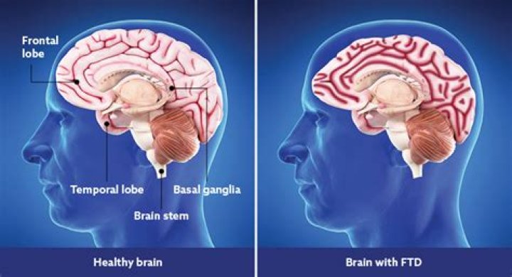 What is the most common cause of damage to the frontal lobe?