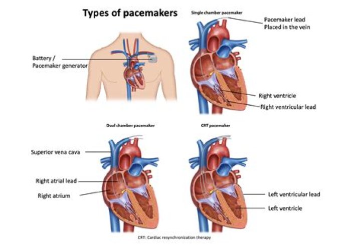 What is the most common complication after permanent pacemaker placement?