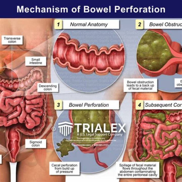 What is the survival rate of a perforated bowel?