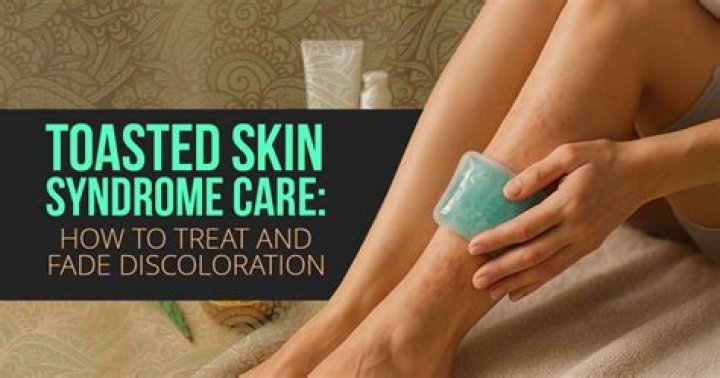 What is toasted skin syndrome?