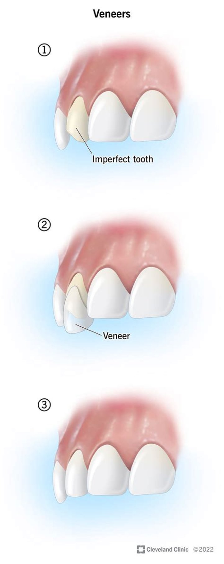 What is veneer plaster used for?