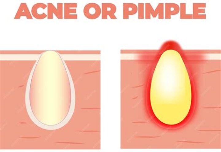 What is yellow pus in a pimple?