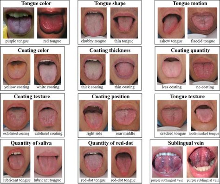 What is yin deficiency tongue?