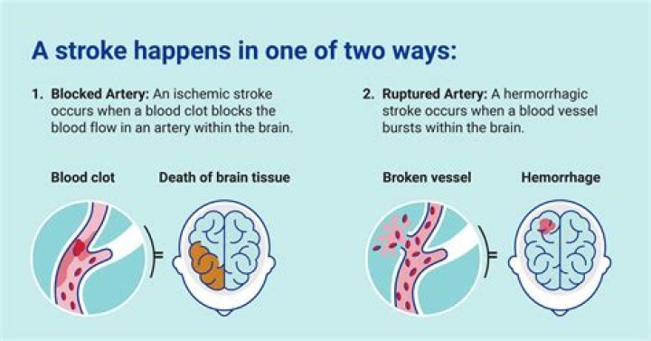 What kind of stroke causes memory loss?