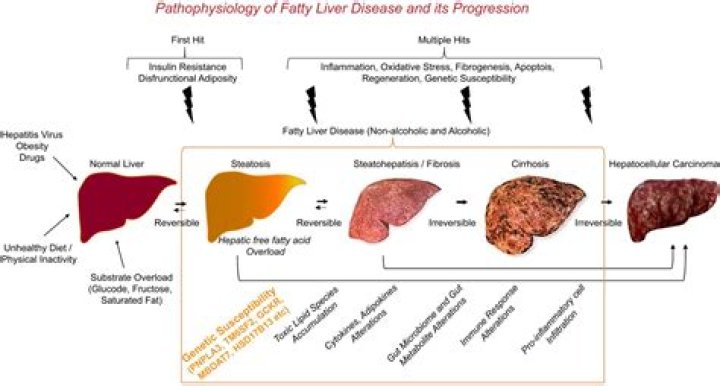What level of ALT is cirrhosis?