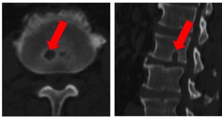 What lumps can be mistaken for cancer?