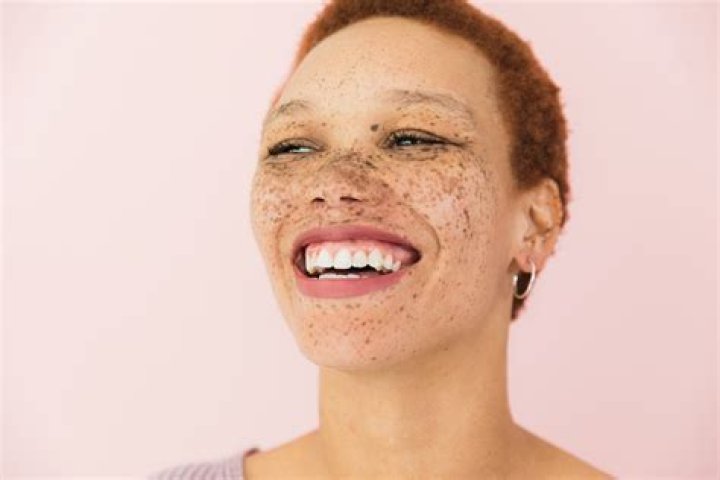 What models have freckles?