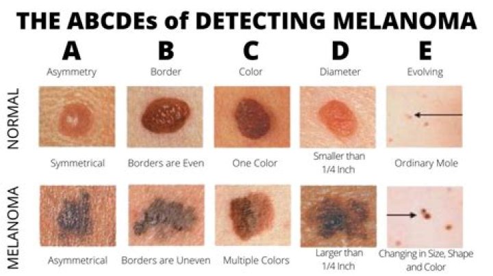 What percentage of moles removed are melanoma?
