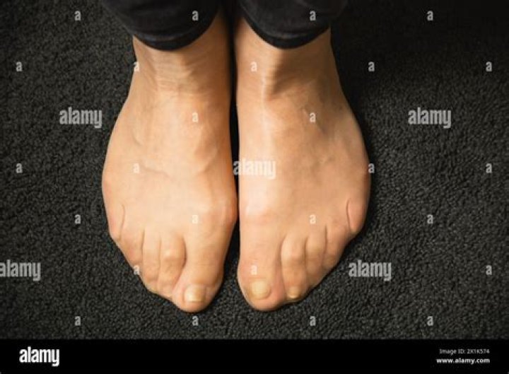What problems can flat feet cause?