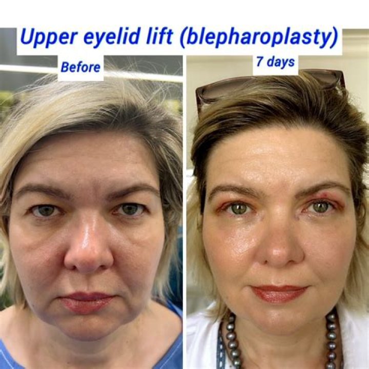 What qualifies you for blepharoplasty?