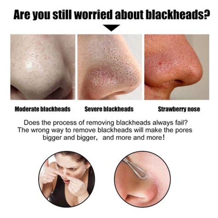 What should I apply after removing blackheads?