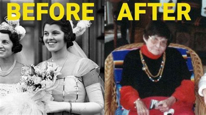 What sister of a former president was given a lobotomy and why what were the results?