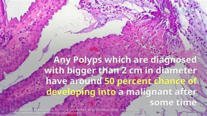 What size polyp is considered large?