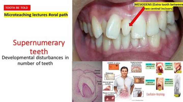 What syndromes are associated with supernumerary teeth?