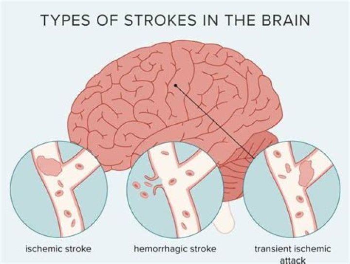 What time of day do strokes normally happen?
