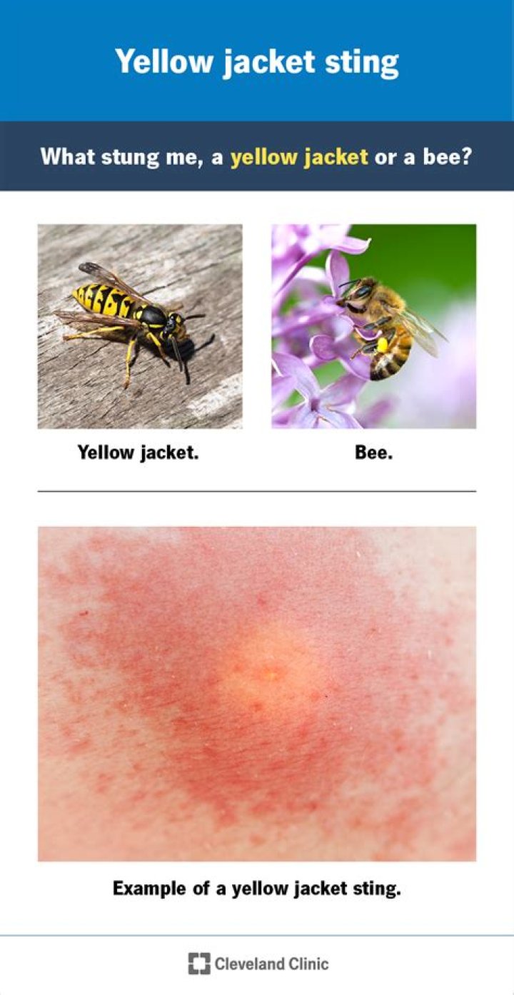 What to do when you get stung by a yellow jacket?