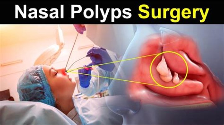 What to expect after polyps are removed?