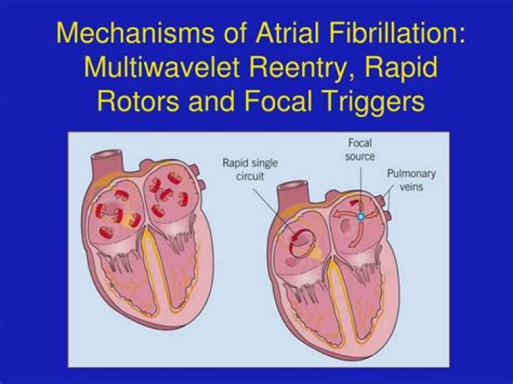 What triggers atrial fibrillation?