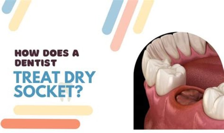 What will a dentist do for dry socket?