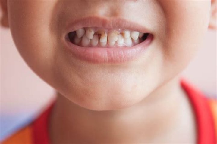 What will a dentist do for toddler tooth decay?