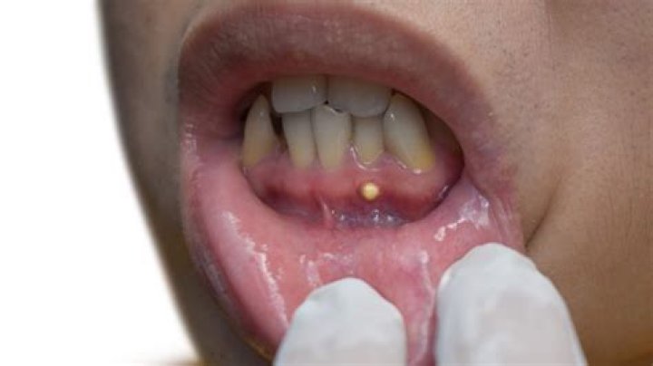 What's a gum boil look like?