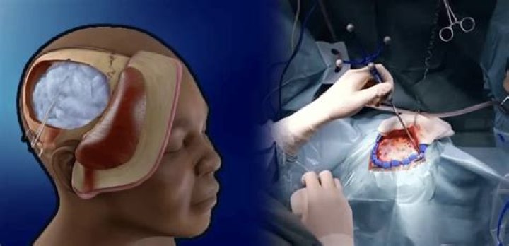 What's the difference between a craniotomy and a craniectomy?