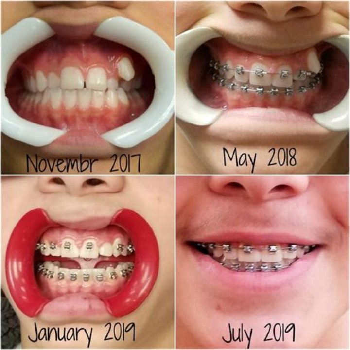 What's the longest time someone has had to wear braces?