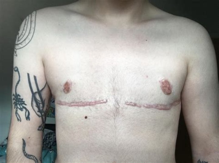 When do scars look worse?