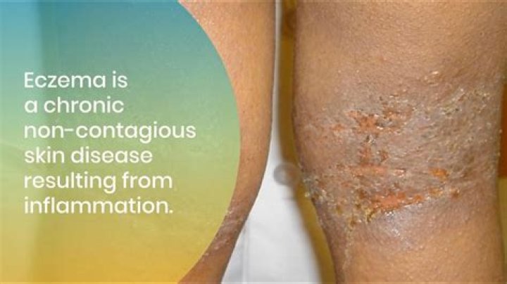 When does eczema heal?