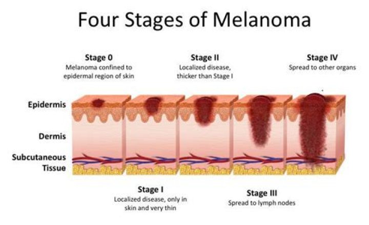 When is melanoma too late?
