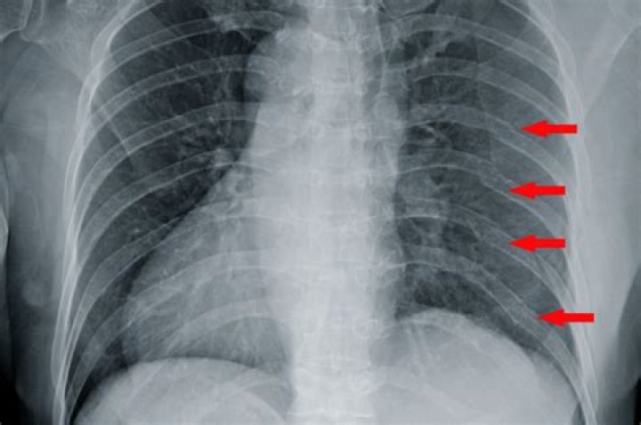 When should I worry about a rib injury?