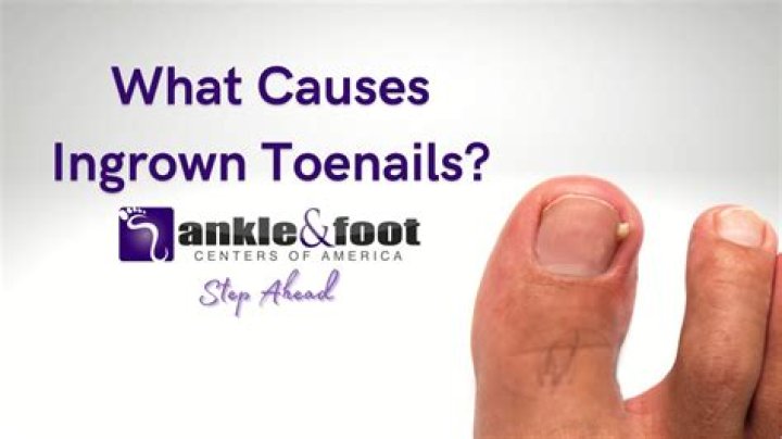 When to go to a doctor for an ingrown toenail?