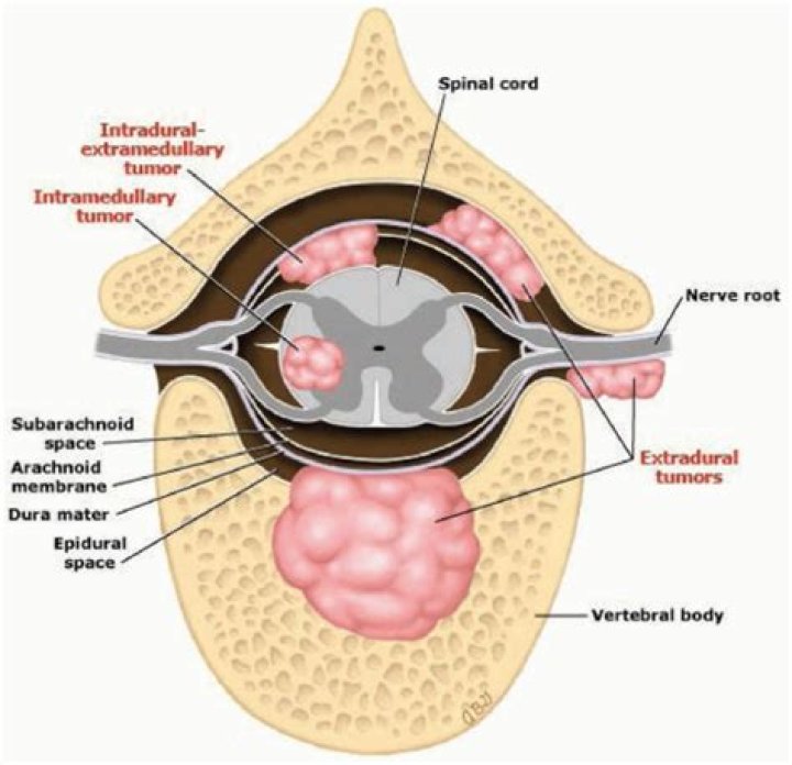 Where are spinal tumors located?